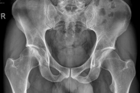 Heupnecrose: MRI & Röntgen